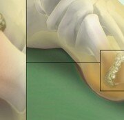 Откуда берется подагра