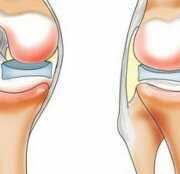 ЗОЖ 1. Артриты и артрозы. Профилактика, восстановление.